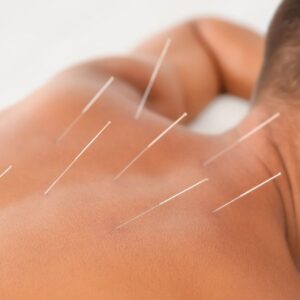 Akupuntur